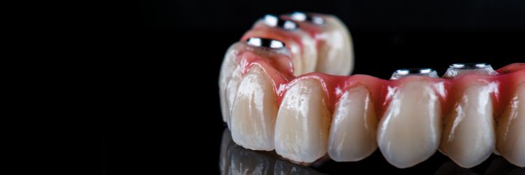 full-arch treatment