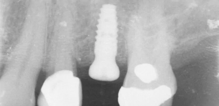 single tooth implant placement