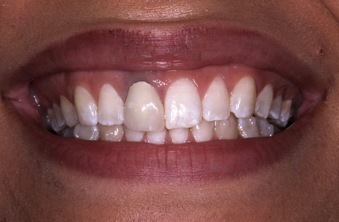 Figure 1: The natural tooth with the dark root visible through the gingiva, also showing the patient’s high smile line