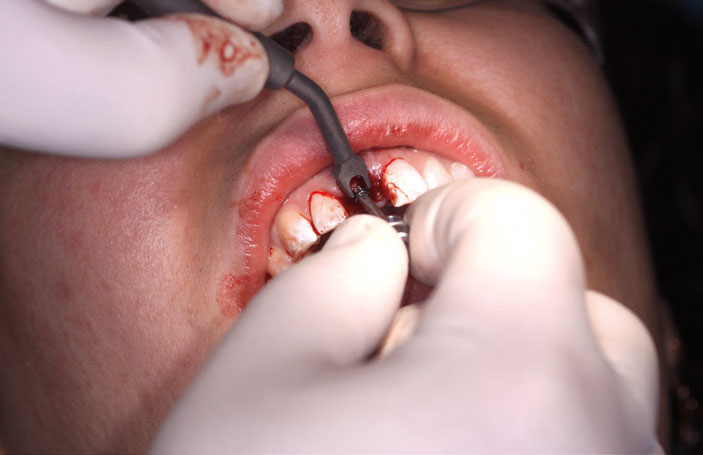 Figure 10: Removing the carrier, using iSy components