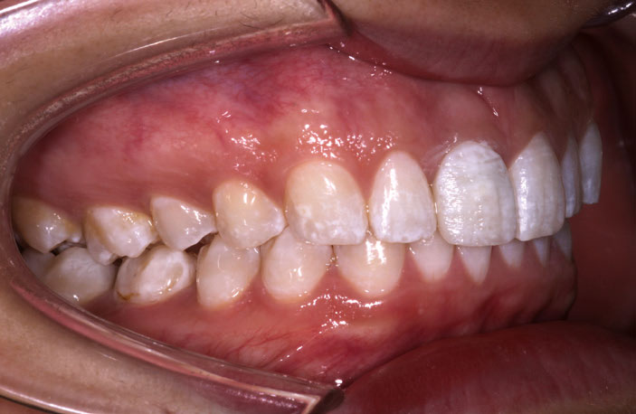 Figure 17: One week later, showing improved gum colour