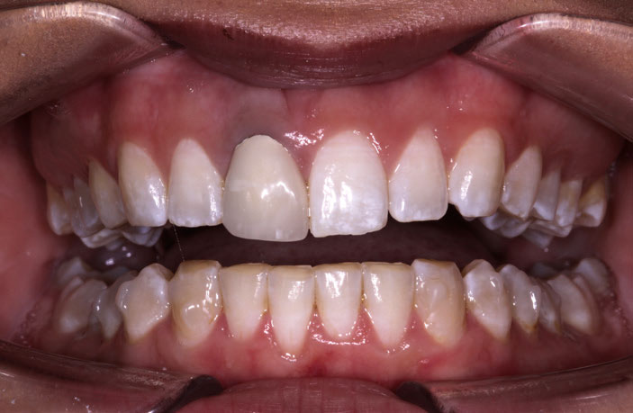 Figure 2: Retracted view