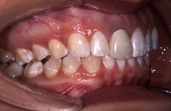 Figure 3: Gum contour pre-treatment looking reasonable, albeit dark