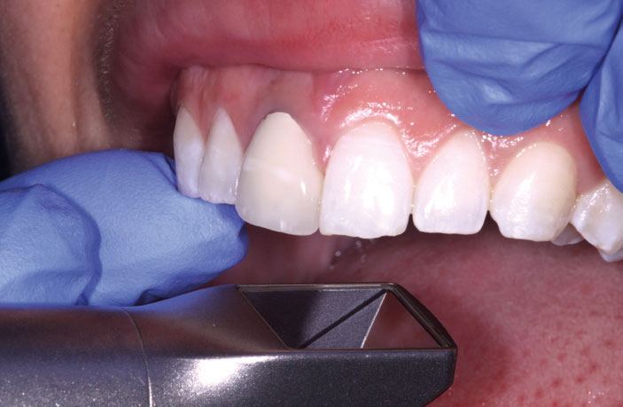 Figure 4: Initial scan to gather information about the crown