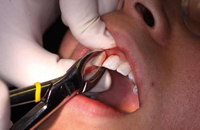 Figure 5: Tooth extraction