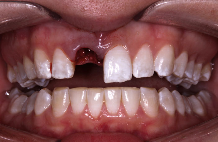 Figure 6: Patient’s smile following extraction