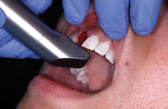 Figure 7: Scanning the soft tissues after root remova