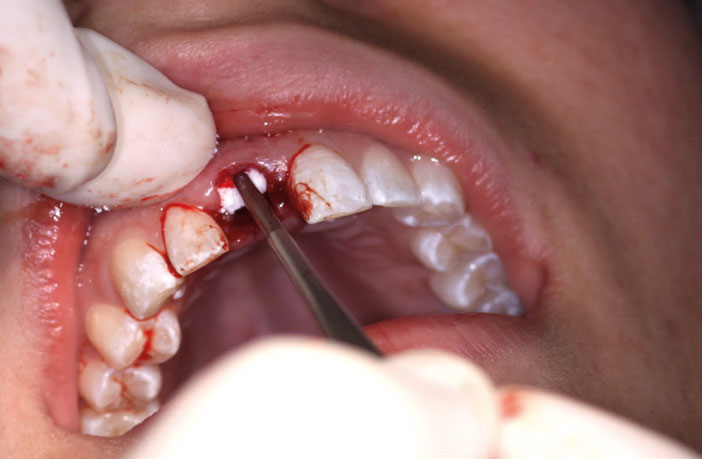 Figure 8: Applying Bio-Oss Collagen in the socket