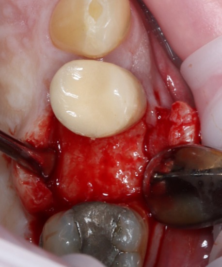 Figure 2 - Initial crestal incision