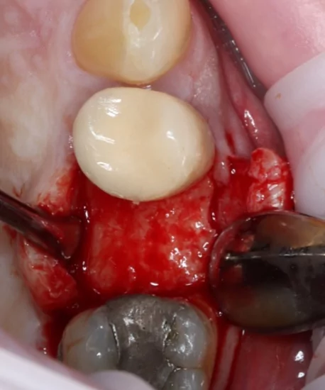Figure 2 - Initial crestal incision