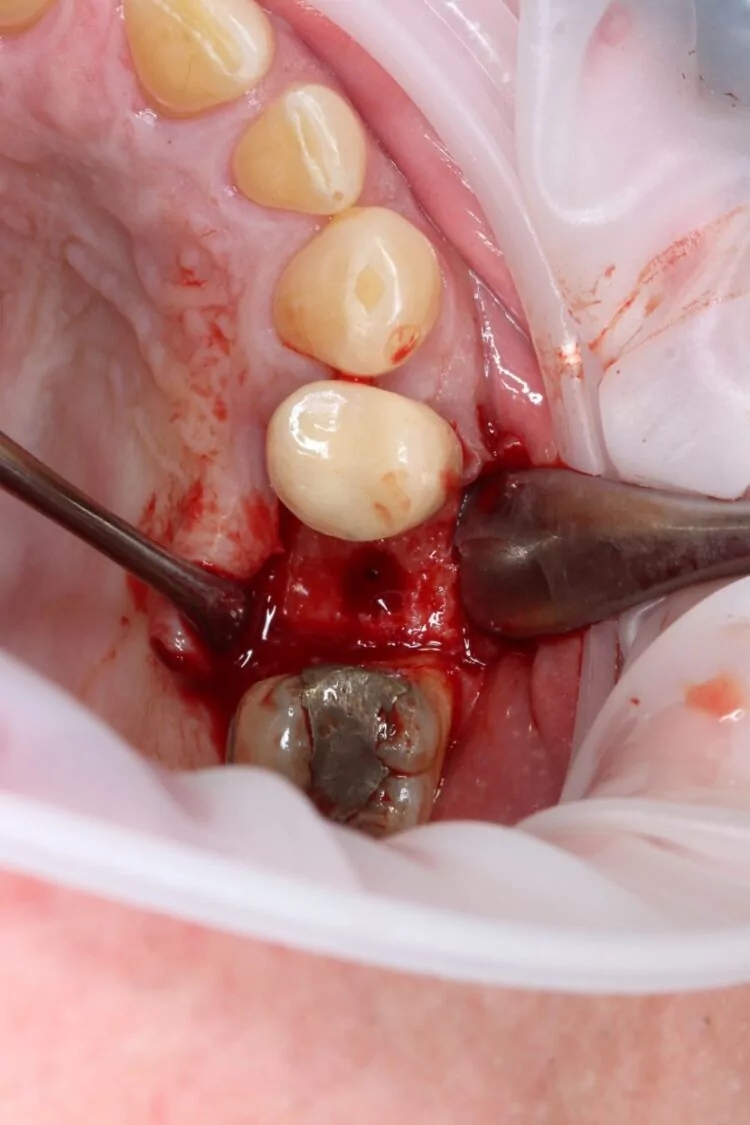 Figure 3 - Completed osteotomy