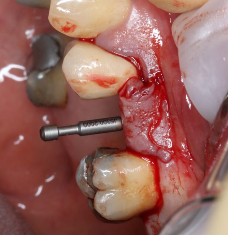 Figure 4 - Guide pin in place to help parallel placement