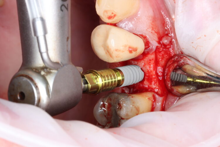 Figure 5 - Conelog implant placement