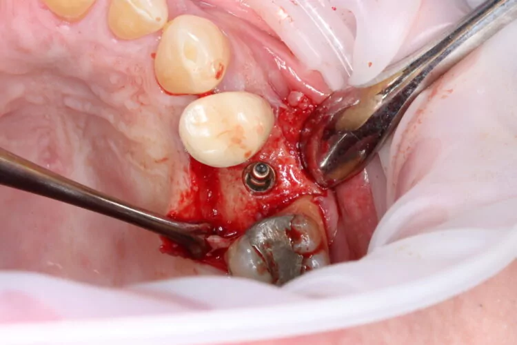Figure 6 - Post placement 1mm sub crestal