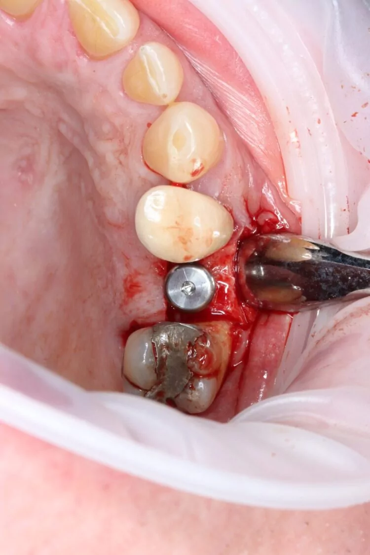 Figure 7 - Healing abutment in place
