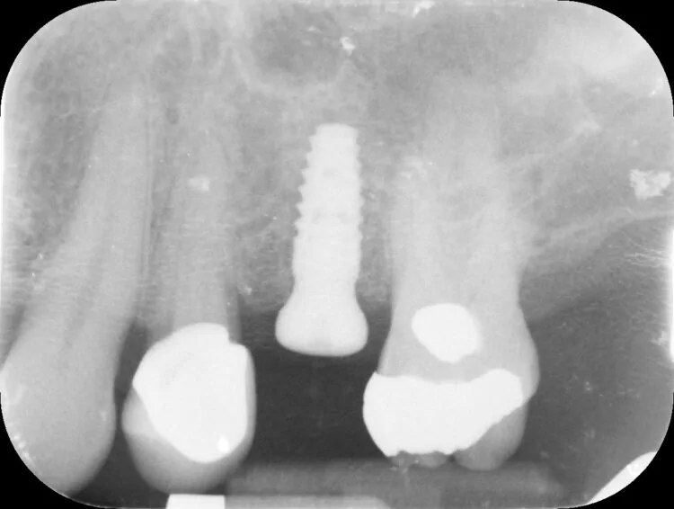Figure 9 - Radiograph