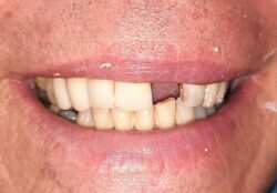 Single implant placement with GBR.