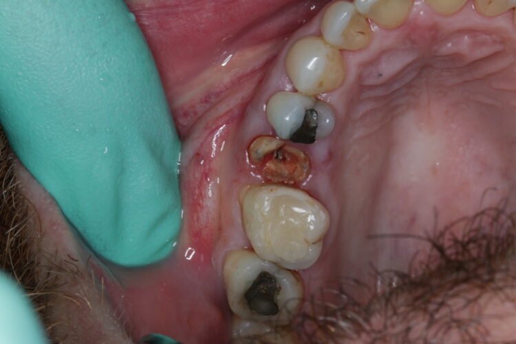 Image 1- bone damage from root fracture