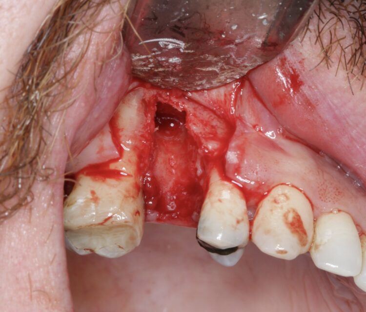 Image 2 - bone damage from root fracture