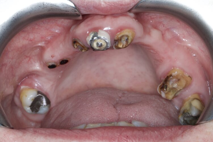 Image 4 - physiological bone resorption, this shows how even broken and carious roots can maintain bone