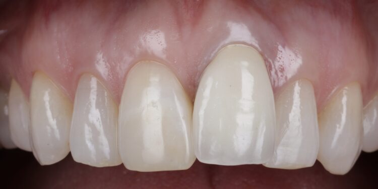 1 - pre op ridge preservation