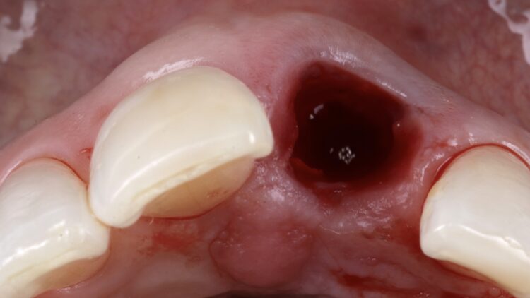 4- extraction ridge preservation