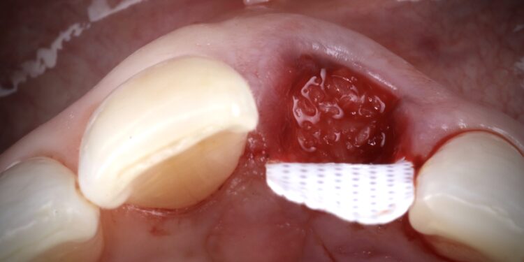 5- graft placement ridge preservation