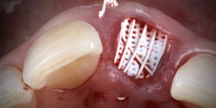 6- membrane stabilisation ridge preservation