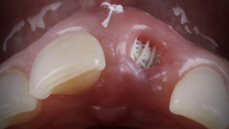 7- 4 weeks healing ridge preservation