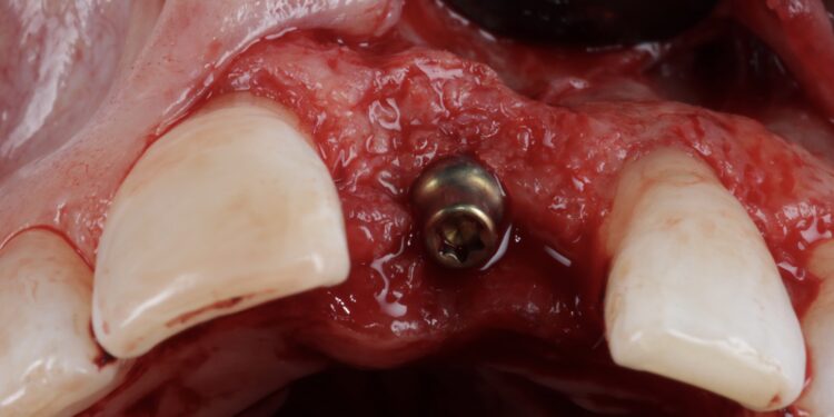 9- implant placement