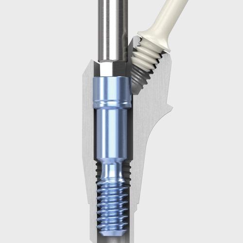 Intra-operative ease