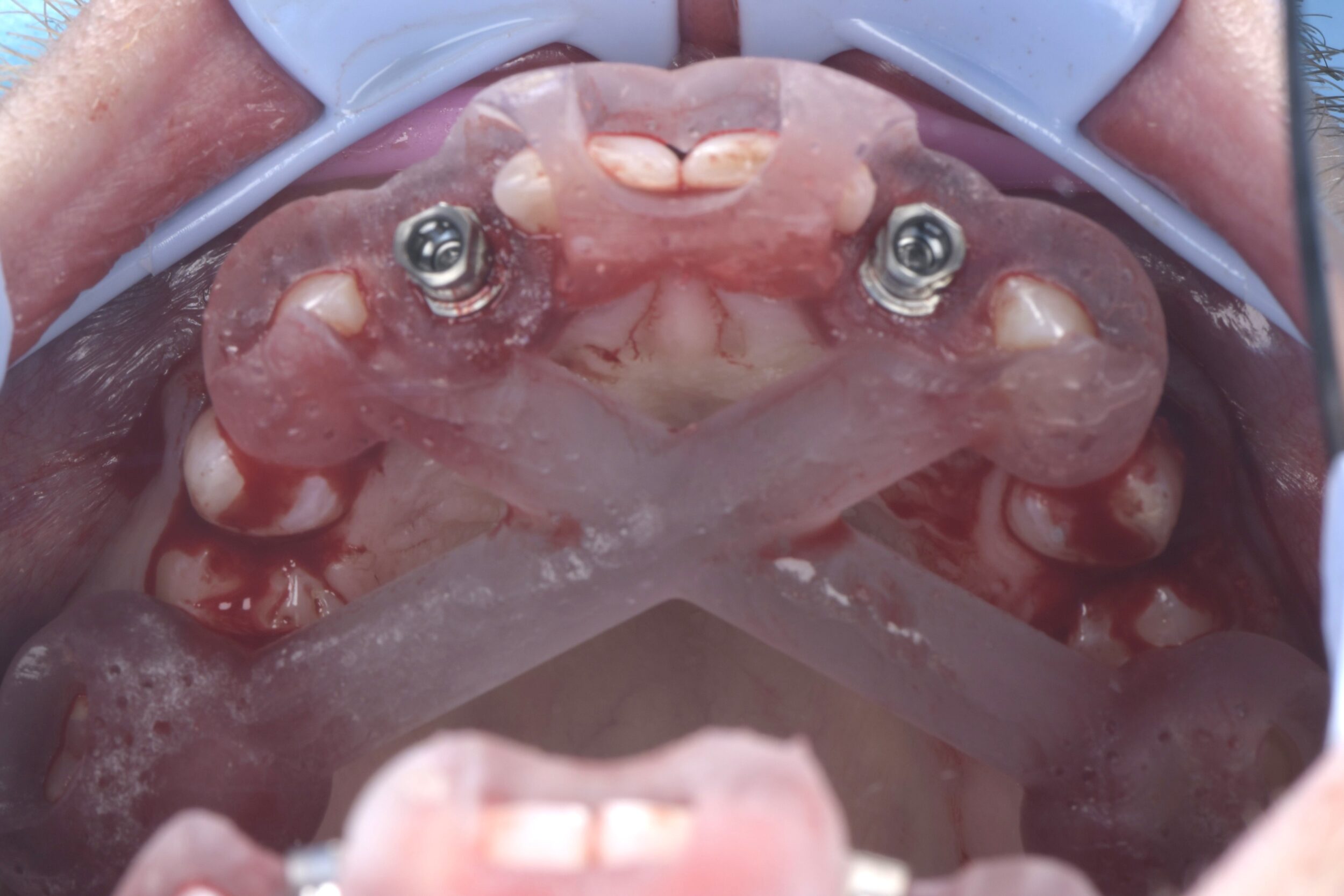 Utilising a guided implant approach for reproducible results Utilising ...