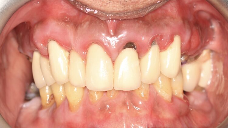 Figure 1: Initial situation frontal view