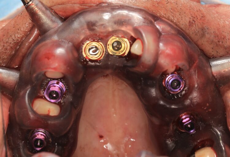 Figure 10: Implants placed through surgical guide