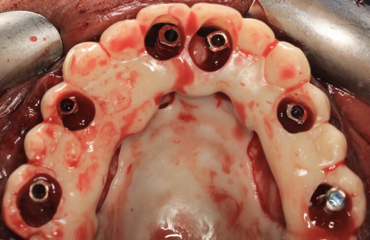 Figure 11: Provisional restoration located in the mouth using the hard palate