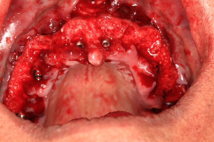 Figure 12: Allograft in the sockets and around the implants