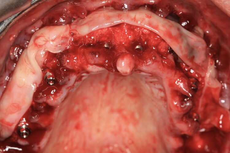 Figure 13: L-Prf for improved healing and soft tissue quality