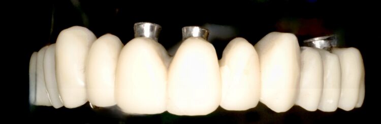 Figure 14a: Provisional restoration Ovate Pontics design