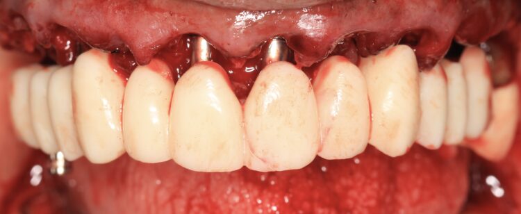 Figure 15: Provisional restoration in situ