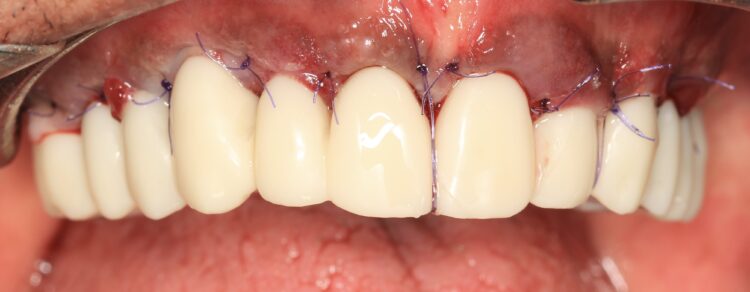 Figure 16: Coronal advancement of the buccal flap