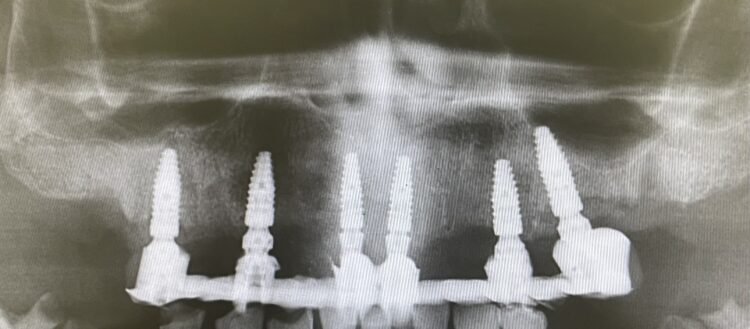 Figure 17: OPG of the provisional restoration in situ