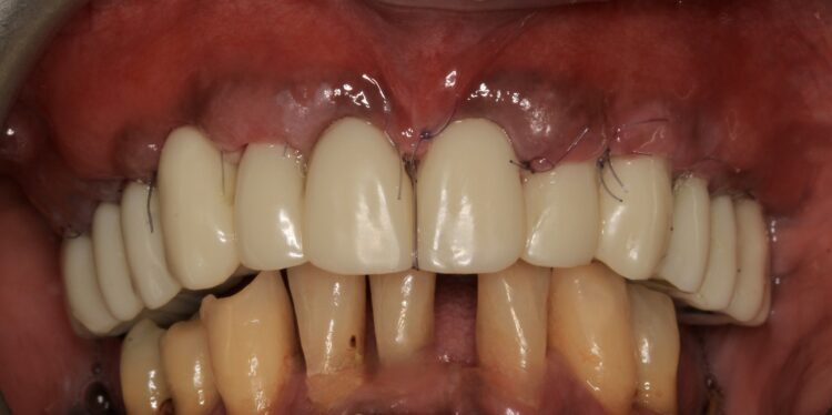 Figure 18: Healing after two weeks