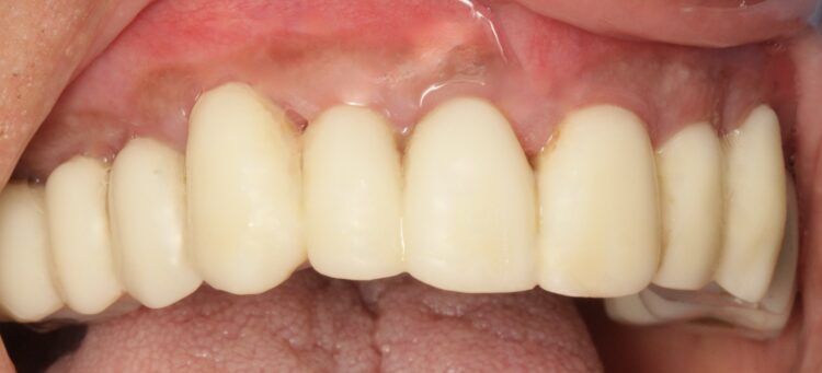 Figure 19: Healing after three months