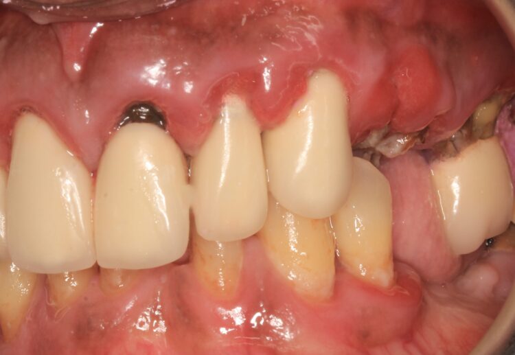 Figure 2: Left lateral view at presentation