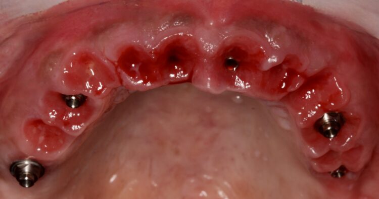 Figure 20: Soft tissue sculpturing during digital impressions
