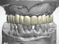 Figure 21a: Digital smile design of the final prosthesis