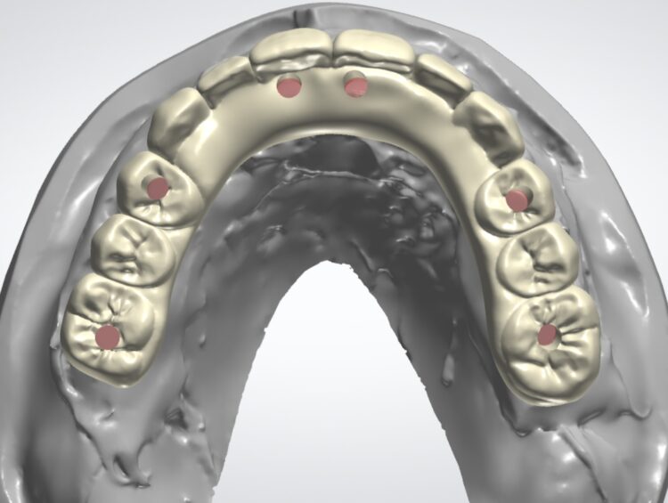 Figure 21b: Final prosthesis digital design occlusal view