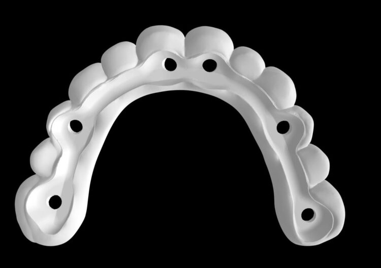 Figure 21d: Zirconia superstructure digital design
