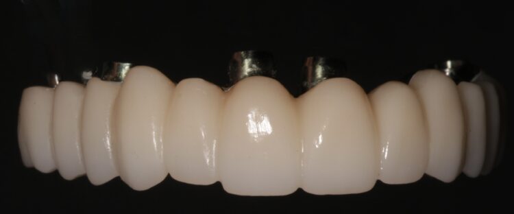 Figure 22a: Final zirconia titanium supported Fp1 prosthesis