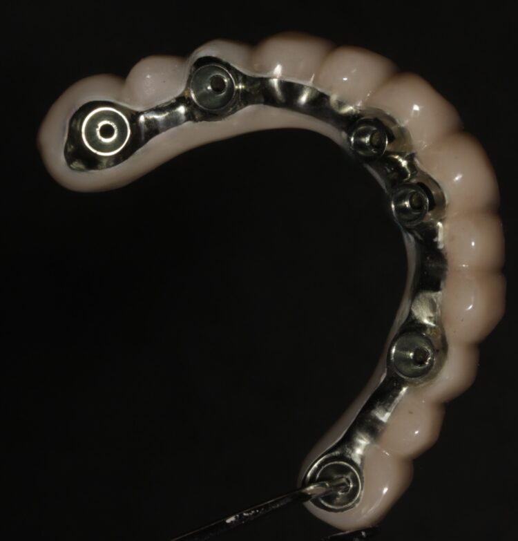 Figure 22b: Final zirconia titanium-supported FP1 prosthesis